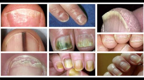 enfermedades de las uñas-1